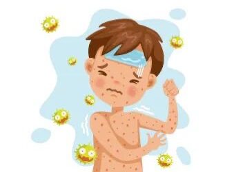 Lebaran Jadi Momen Rawan Penularan Campak, Ini Imbauan Dinkes Kaltim